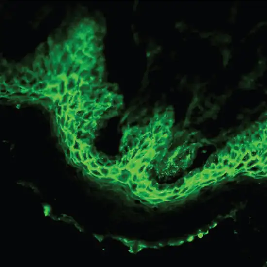 histopathology direct immunofluorescence skin,conjunctival biopsy